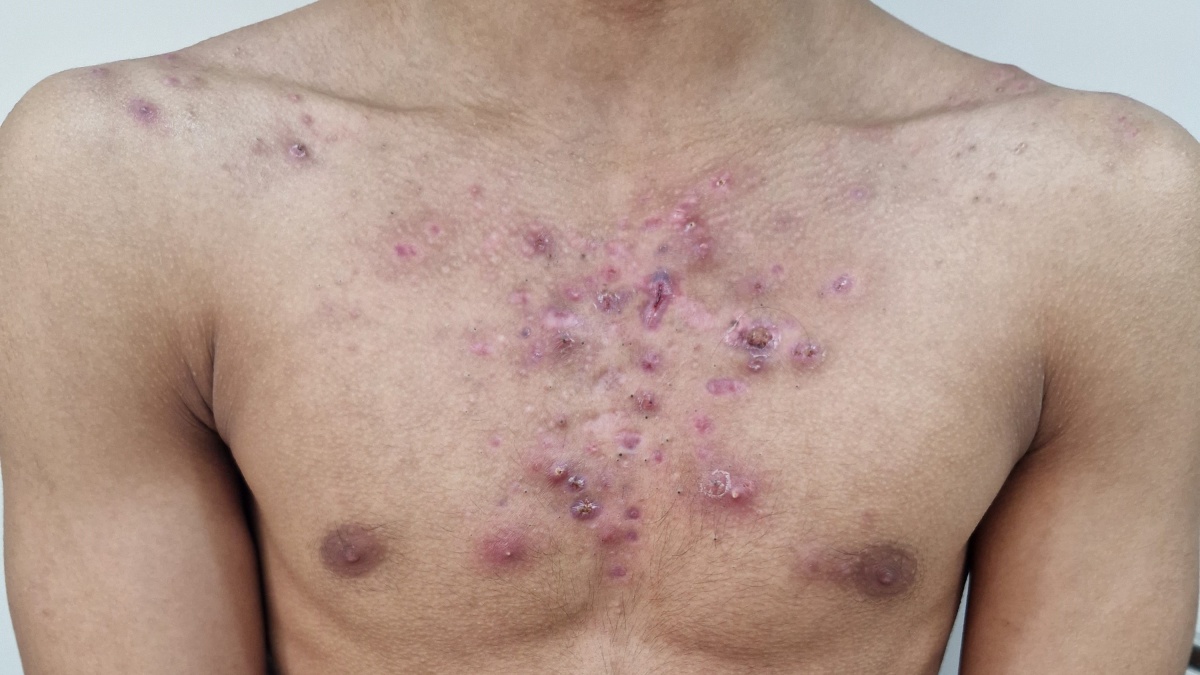 19letý kulturista se může pochlubit neskutečnou formou. Steroidy odmítá, jeho akné však děsí